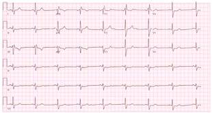 EKG
